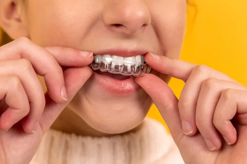 Patient placing a clear invisible aligner